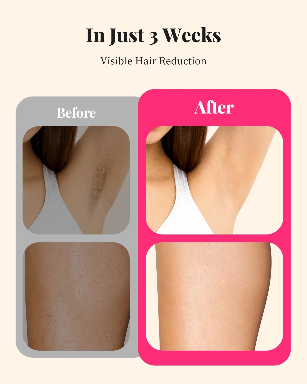 990000 Flashes Laser Hair Removal for Women and Men